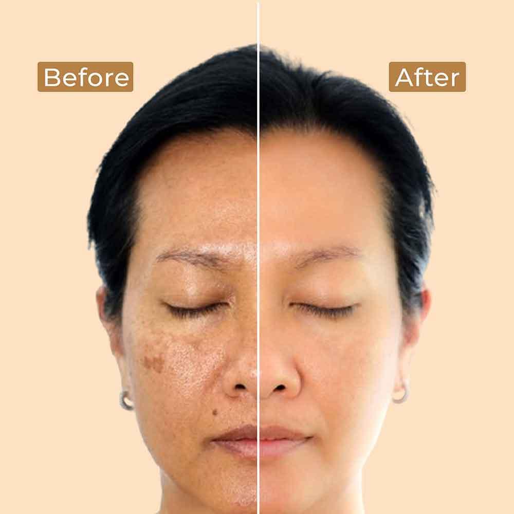 Brightening Depigmentation Gel - before and after