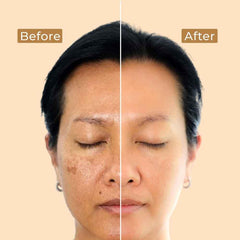 Brightening Depigmentation Gel - before and after