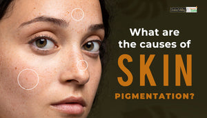 What Are the Causes of Skin Pigmentation and How to Tackle It?