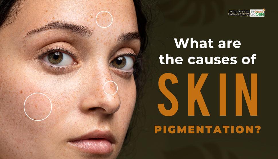Causes of Skin Pigmentation