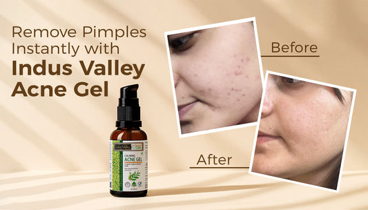 Remove pimples instantly with Indus valley acne gel