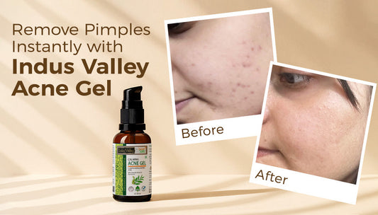 Remove pimples instantly with Indus valley Acne gel
