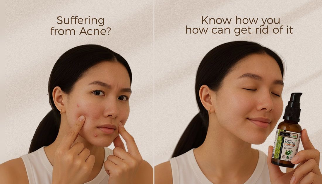 How to get rid of acne