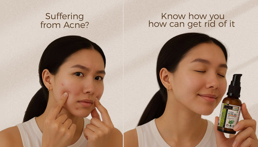 How to get rid of acne